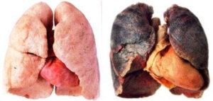 Stoppen met roken in Breda en omgeving